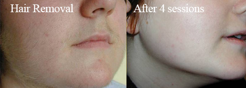 IPL Hair removal example5